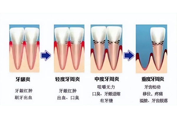 严重牙周炎吃什么药好得快一点呢(严