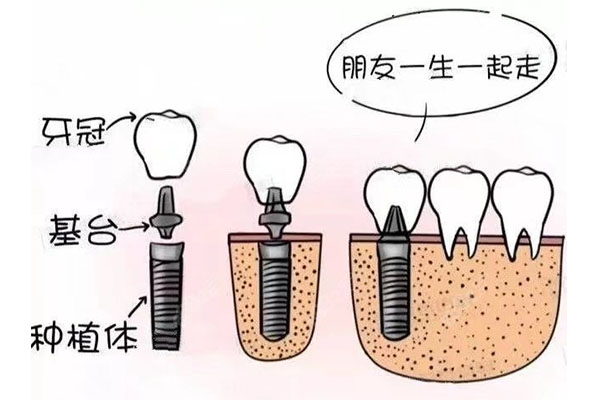 30多岁种牙会不会不太好呢(30多岁种牙