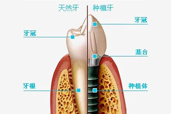 12岁小孩矫正牙齿选哪种牙套最好用(12岁孩子整牙用什么样的牙