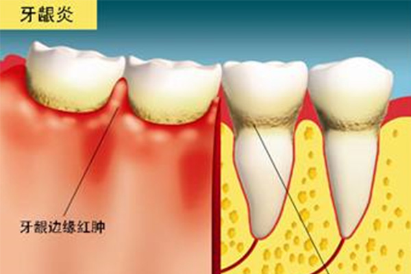 28牙髓炎是什么意思(36牙髓炎)