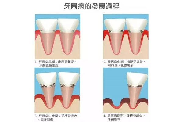 中医治牙周炎牙齿松动怎么治(中医治