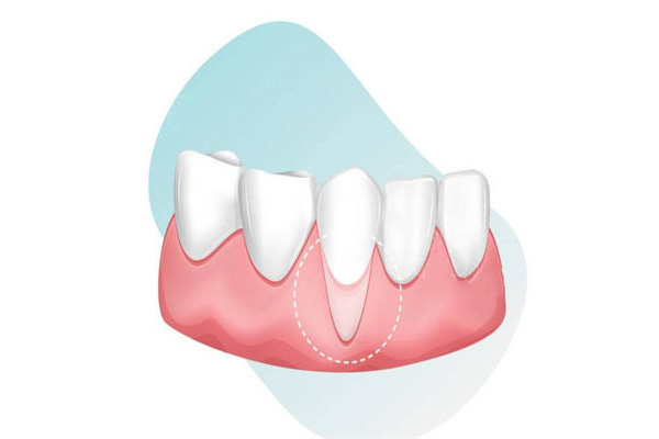 33岁牙龈萎缩严重怎么治疗(33岁牙龈萎
