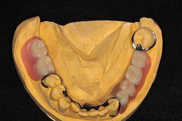 活动假牙支架什么材料好,价格(活动假牙支架什么材料好,价格便