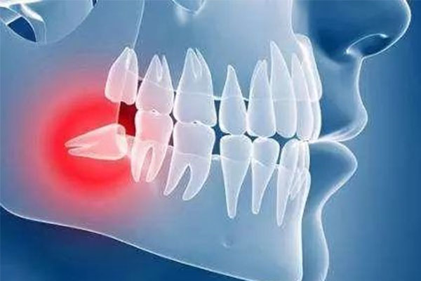 48低位水平埋伏阻生(低位水平埋伏阻生智齿需要拔掉吗?)
