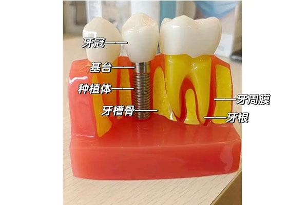 70岁以上适合种牙吗(70岁以上适合种牙吗视频)