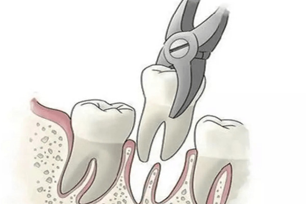 38阻生牙难拔吗(38阻生牙是什么意思好