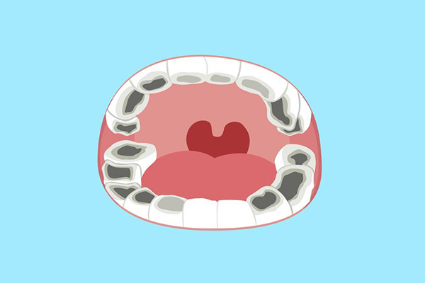 12岁以上出现蛀牙怎么办(12岁以上出现蛀牙怎么办呀)