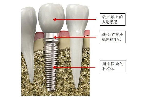 2020年种牙技术怎么样了啊(2020年种牙