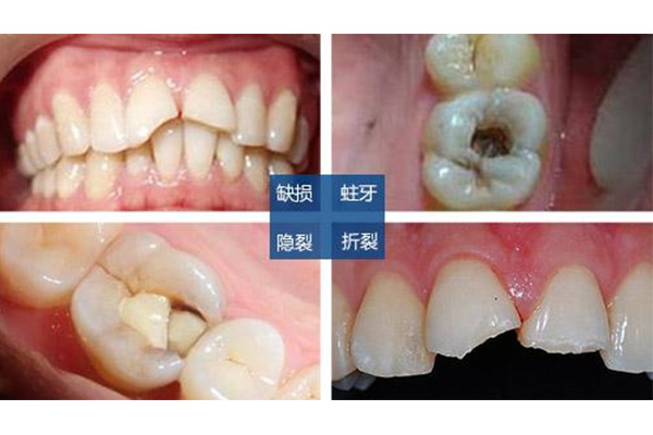 牙体缺损修复方案(牙体缺损修复方案