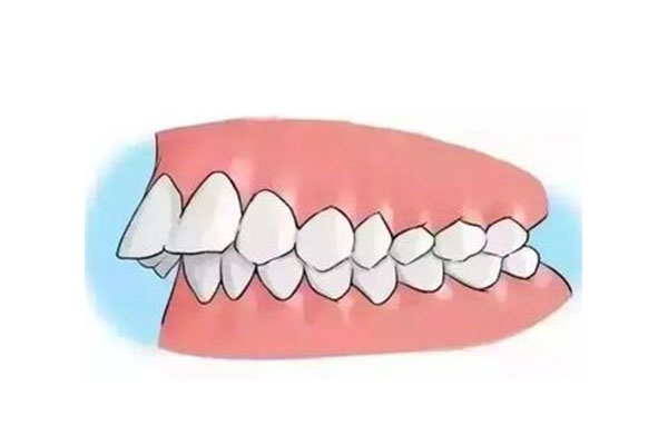 牙齿有点天包地需要矫正吗(牙齿天包地严重)