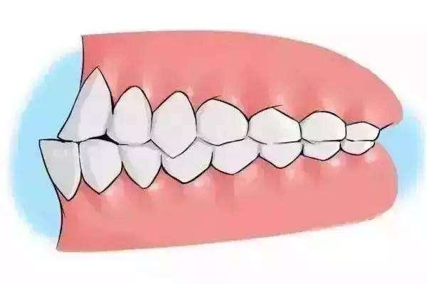11岁地包天矫正后的咬合问题(地包天