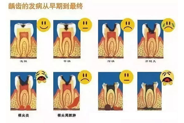 11岁小孩蛀牙怎么治疗(11岁小孩蛀牙怎