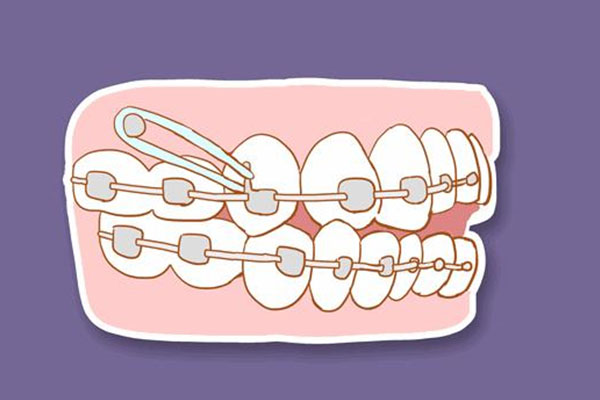 孩子牙齿拥挤带扩张器时间久了会把