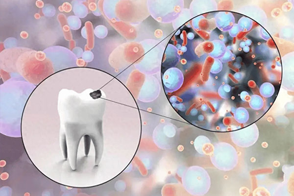 22岁牙齿蛀牙严重吗怎么治(22岁牙齿蛀
