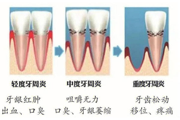 中医治疗牙周炎怎样治疗效果好最好