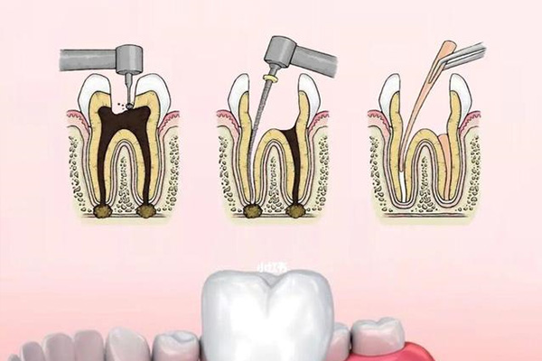 一个牙根管治疗要多久(一个牙根管治疗要多久完成)