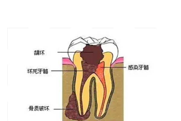 10岁儿童蛀牙已经烂空了怎么办呀(1