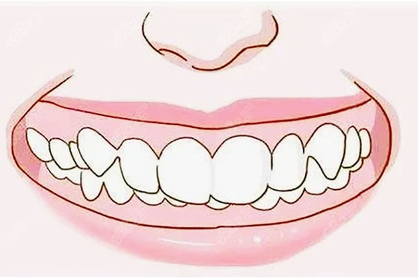 18岁地包天牙齿矫正(18岁地包天牙齿矫
