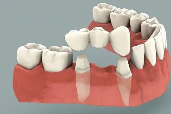 3d烤瓷牙(3d烤瓷牙是什么材质)