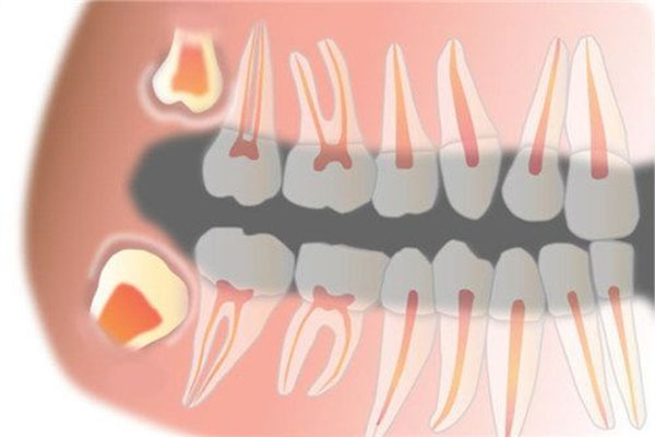 19岁最里面长了一颗牙属不属于智齿