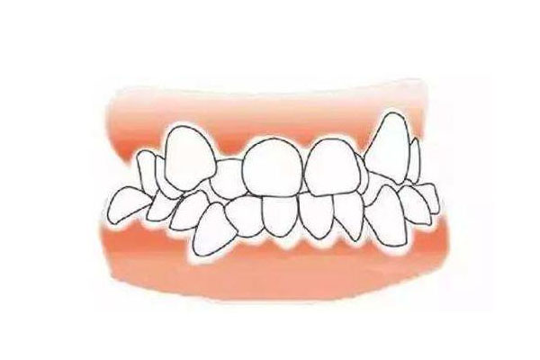 36岁了牙齿不齐如何纠正(36岁了牙齿不