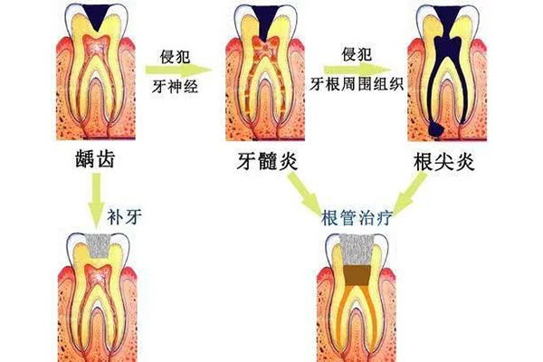 一般根管治疗要多少钱一颗牙(一般根