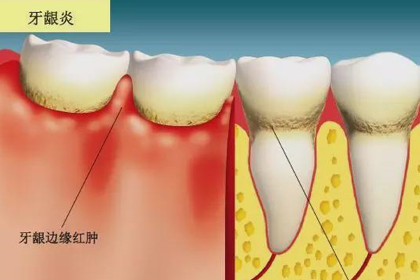 一岁宝宝牙龈出血红肿是什么原因造