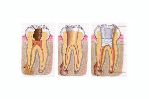 一颗牙可以做几次根管治疗吗(一颗牙