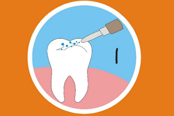 3m窝沟封闭剂使用方法(3m窝沟封闭剂说