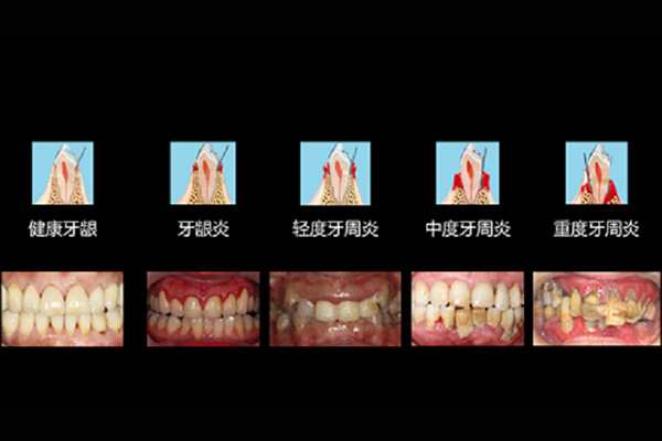 一味中药治牙周炎 特效药有哪些名字