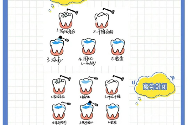 6岁孩子做窝沟封闭(6岁孩子做窝沟封