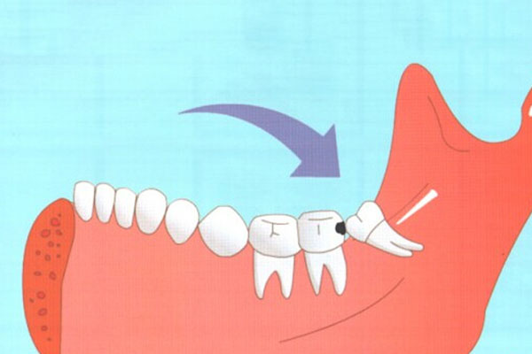 中医认为拔智齿的长期危害有哪些(中