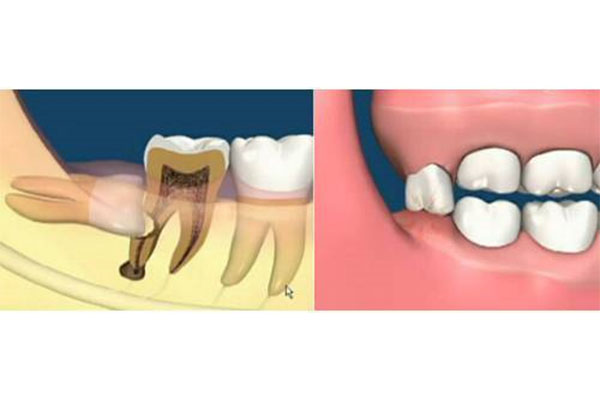 为什么智齿必须拔掉