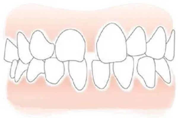 成人牙齿有点龅牙怎么办(成人有点龅牙怎么改善)