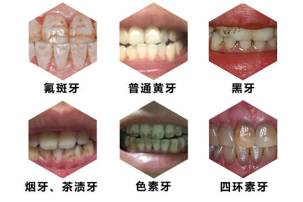 原牙色素提取的注意事项是哪些