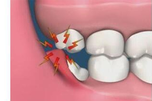 为什么突然长智齿,代表什么(为什么突