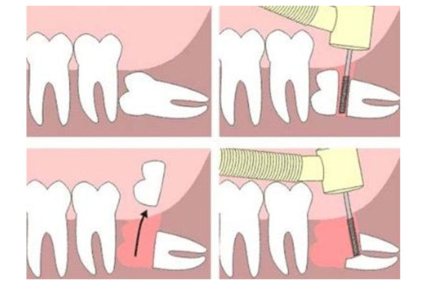 为什么牙科医生都建议拔掉智齿