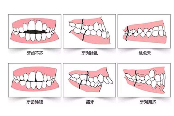 小孩长龅牙怎么办(小孩长龅牙怎么办乳牙还拨)