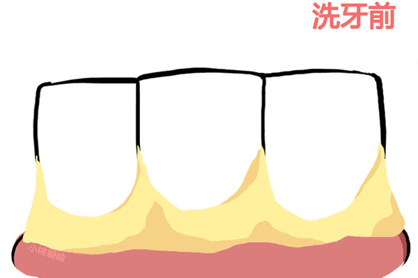 为什么牙齿越来越黄黑了怎么办