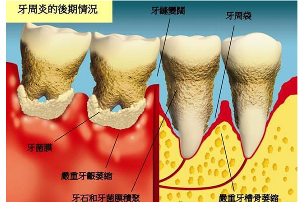 50岁女牙龈萎缩怎么办呢(50岁女牙龈萎