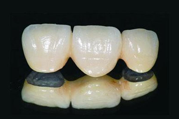 仿生牙和烤瓷牙区别(仿生牙和烤瓷牙