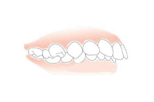 33岁牙齿地包天如何矫正(33岁地包天能做牙齿矫正吗)