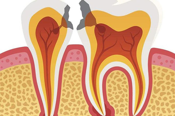 牙体缺损大做牙冠可以吗多少钱(牙体缺损大做牙冠可以吗多少钱