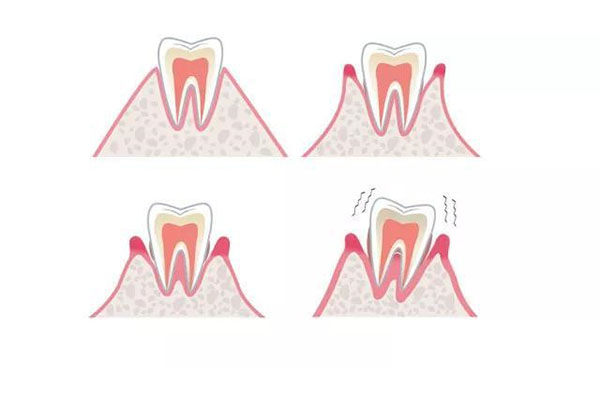40岁牙齿松动是什么原因引起的怎么治
