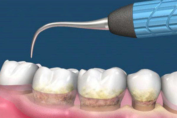 不清洗牙结石(不清洗牙结石的危害)